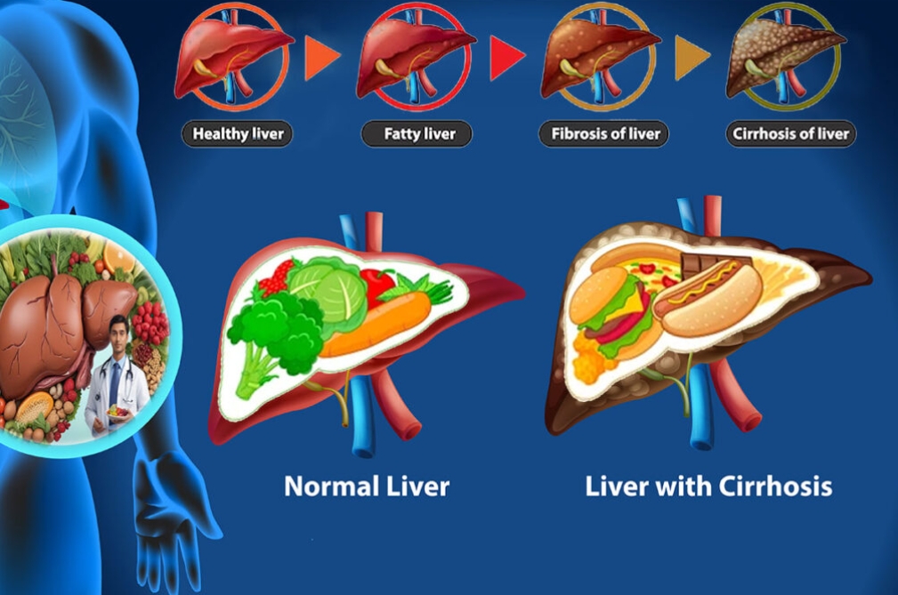 Fatty Liver Diet Plan