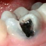 Cavity in Teeth Stages