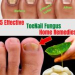 Top 7 Antifungal Toenail Home Remedies: Natural Ways to Restore Healthy Nails Antifungal Toenail Home Remedies