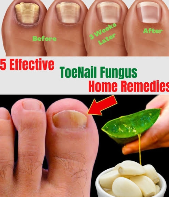 Antifungal Toenail Home Remedies